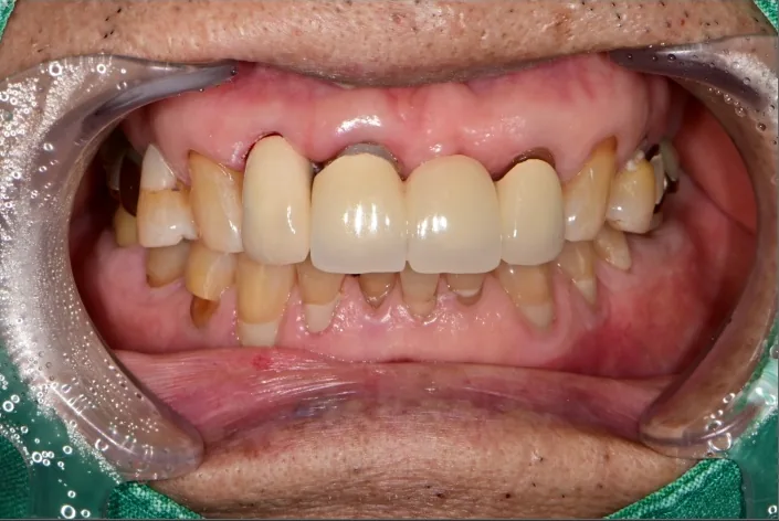 사례 2 치료 후 구강 사진 — 금속 기둥 위에 크라운을 씌운 위 앞니 쪽 치아